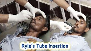 Ryle's Tube Insertion Procedure  Nasogastric tube Insertion hindi