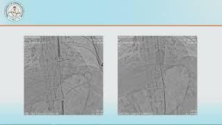 Session 08: Thoracic Endovascular Aortic Repair (TEVAR): Beginning of A New Era for Bangladesh