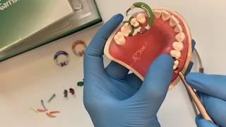 Garrison Composi Tight 3D Fusion Anwendungstutorial deutsch Garrisondental, Teilmatrizen