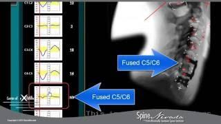 Vertebral Motion Analysis for testing cervical spine motion at Spine Nevada, Reno, Sparks, Carson