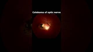 What diseases cause optic nerve damage