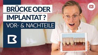 ZAHNBRÜCKE oder IMPLANTAT: Vor- & Nachteile; 3D Animation!