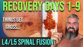 L4/L5 Spinal Fusion And Decompression 9 Days After Surgery...Things Are Getting Gross!