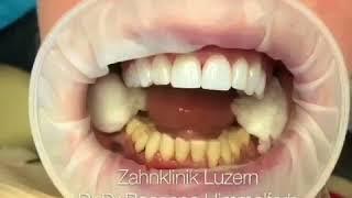 Zahnklinik Luzern Dr.Dr.Rosanna Himmelfarb Lumineers & Veneers