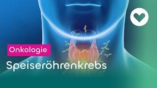 Speiseröhrenkrebs - Symptome, Risikofaktoren und Therapie