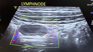 Lymphnode with internal necrotic changes.