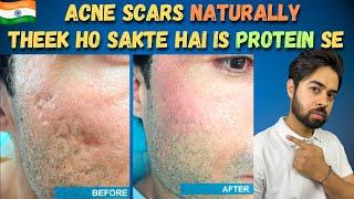 Remove Acne Scars Naturally | 3 Remedies (100% Works) With Results