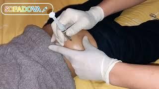 Injection into the buttock. intramuscular injection original video