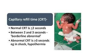 Capillary Refill Time (CRT) Assessment in newborn | Pediatrics
