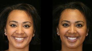 Zoom Dental Whitening | Thousand Oaks Cosmetic Dentistry