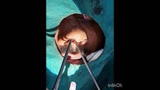 caumoflauge rhinoplasty. dr jalil mujawar