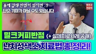 난치성 색소 ‘밀크커피반점’ 없애는 법! (치료방법, 실제 치료사례 공개)