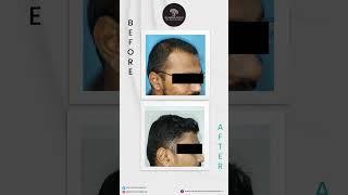 Successful Hair Transplant Results |  Dr. Rashmi Aderao Skin, Hair & Laser Clinic |  #hairloss