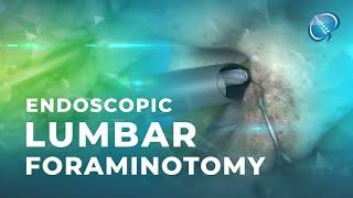 What is Endoscopic Lumbar Foraminotomy?