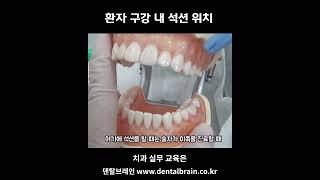 환자 구강 내 석션 위치  #치과위생사  #치위생사 #치과