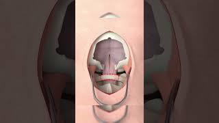 Craniotomia #medico #neurocirurgia #shorts