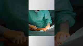 Watch This Stunning Arm Liposuction Before-and-After Transformation | Cosmetique