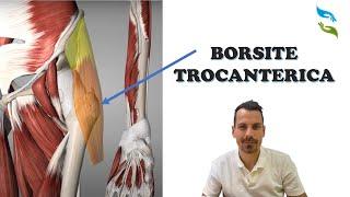 Dolore d'Anca? Forse è una Borsite Trocanterica!