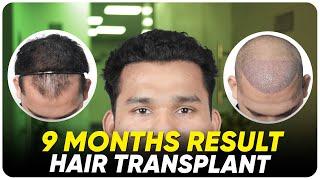 Hair Transplant in India | Best Results & Cost of Hair Transplant in India