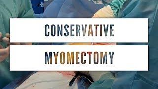 Сonservative myomectomy  Консервативна міомектомія