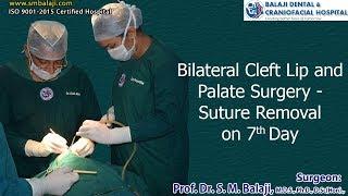 Bilateral Cleft Lip and Palate Surgery suture removal  on 7th day