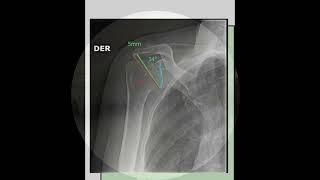 Arthroscopic Lateral Acromioplasty