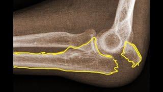 Olecranon Fracture Tension Band Wiring Technique. (A touch Surgery - Apps TM)