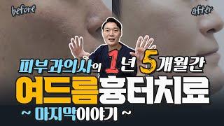 피부과의사의 1년5개월간 여드름치료흉터 마지막 이야기. 여드름흉터원정대 25탄.