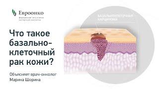 Насколько опасен базальноклеточный рак кожи? Как его лечат? Рассказывает врач-онколог Марина Шорина