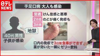 【解説】大人も注意…手足口病  「ガラスが刺さったみたい」「地獄」  9月入っても“警報級”流行『知りたいッ！』