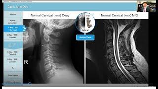 X Ray versus MRI of the Spine