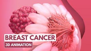 5 Signs of Breast cancer | 3D Animation