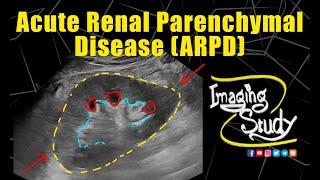 Acute Renal Parenchymal Disease || Ultrasound || Case 333