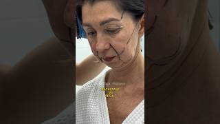 Фейслифтинг. Круговая блефаропластика. Доктор НИКОЛАЕВА САНДАРА