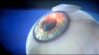 Lasik Eye Surgery - 3D Medical Animation || ABP ©