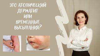 Атопический дерматит или временные высыпания на коже? Как узнать?