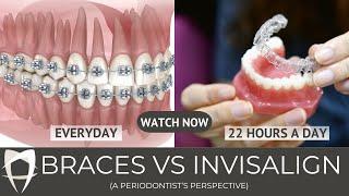 The Secrets of Braces vs Invisalign!