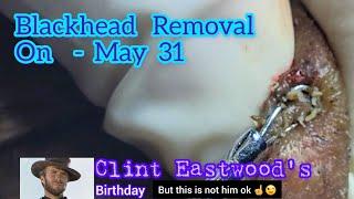 Blackhead removal on May 31st!!! #blackheadremoval #blackheads |@Dr.AMAZINGSKIN