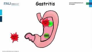 Innere Medizin ─ Gastritis