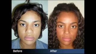 Rhinoplasty Before & After - Plastic Surgeon New York