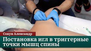 Постановка игл в триггерные точки мышц спины. Сокун Александр