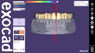 exocad Quick Guide: Designing a single arch denture