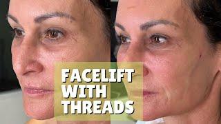 MARICU NON SURGICAL FACE LIFT WITH THREADS | Dr. Jason Emer