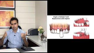 Option For Permanent Teeth Replacement | Expert Talk | In Gujarati Language with English Subtitle