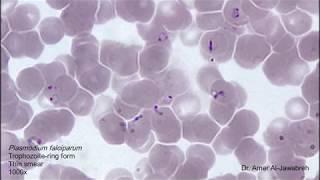 Plasmodium falciparum: ring form in thin blood smear