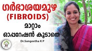 ഗർഭാശയമുഴ  (Fibroids)  മാറ്റാം   ഓപ്പറേഷൻ കൂടാതെ | ഗർഭാശയമുഴ ക്യാൻസറാണോ ? | Health 4 Happiness