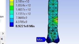 Biomechanal FEA Simulation of Femur bone of human Knee joint by Solidworks and ANSYS