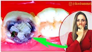 AMAZING: Homemade Toothache Recipe disappears in 5 MINUTES!! You have it at home!!