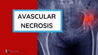 What is Avascular Necrosis (AVN)? | Why does it happen? Who gets it? How do you diagnose it?