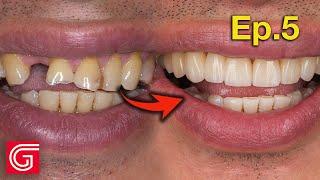 Delivering ZIRCONIA Crowns with Missing Tooth on #7 | Ep5